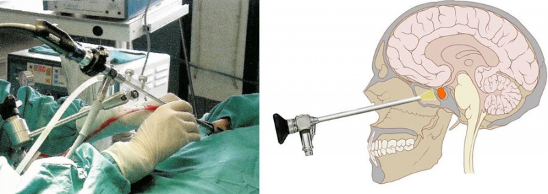 Operation der Hirnanhangdrüse (Hypophyse) durch die Nase mittels Endoskop