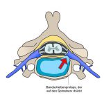Bandscheiben – Vorwölbung/ -Vorfall Quelle: wikimedia.org