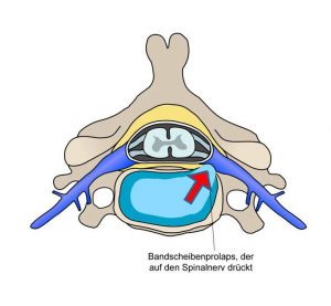 Bandscheiben – Vorwölbung/ -Vorfall Quelle: wikimedia.org