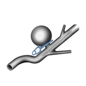 Aneurysma wird mit Clip mikrochirurgisch ausgeschaltet