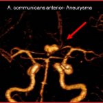 A. communicans anterior-Aneurysma